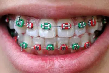 Comment se faire rembourser l'orthodontie chez l'adulte