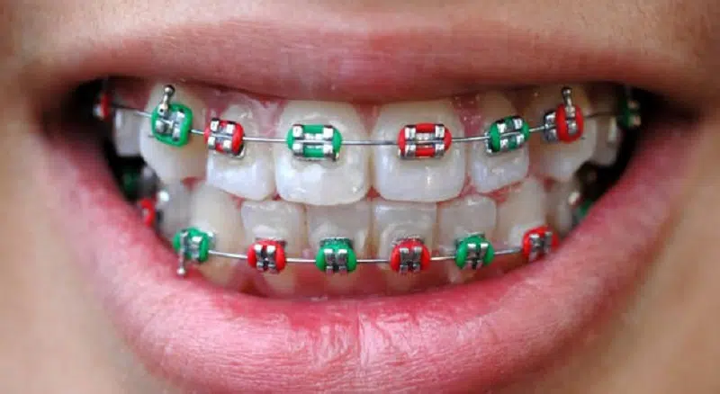 Comment se faire rembourser l'orthodontie chez l'adulte