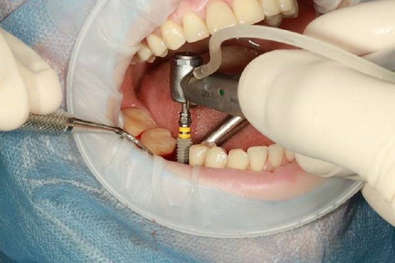 Comment se passer l'implantologie dentaire
