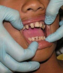 Les remèdes efficaces face à la rage de dents
