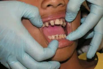 Les remèdes efficaces face à la rage de dents