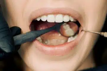 Les soins dentaires comment prévenir les caries et les problèmes dentaires