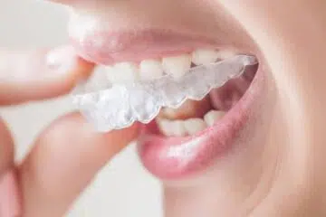 Quand opter pour la solution invisalign