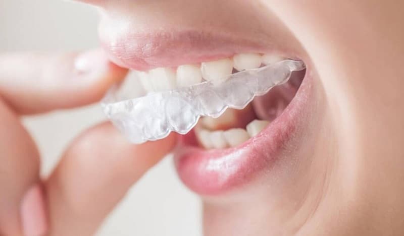 Quand opter pour la solution invisalign