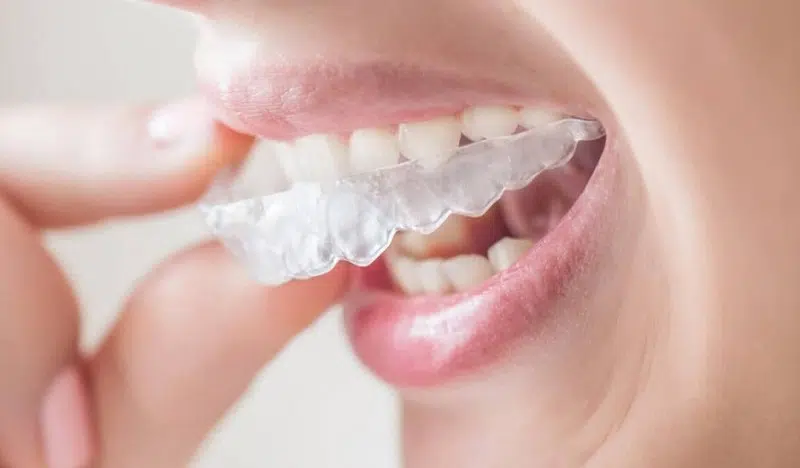 Quand opter pour la solution invisalign