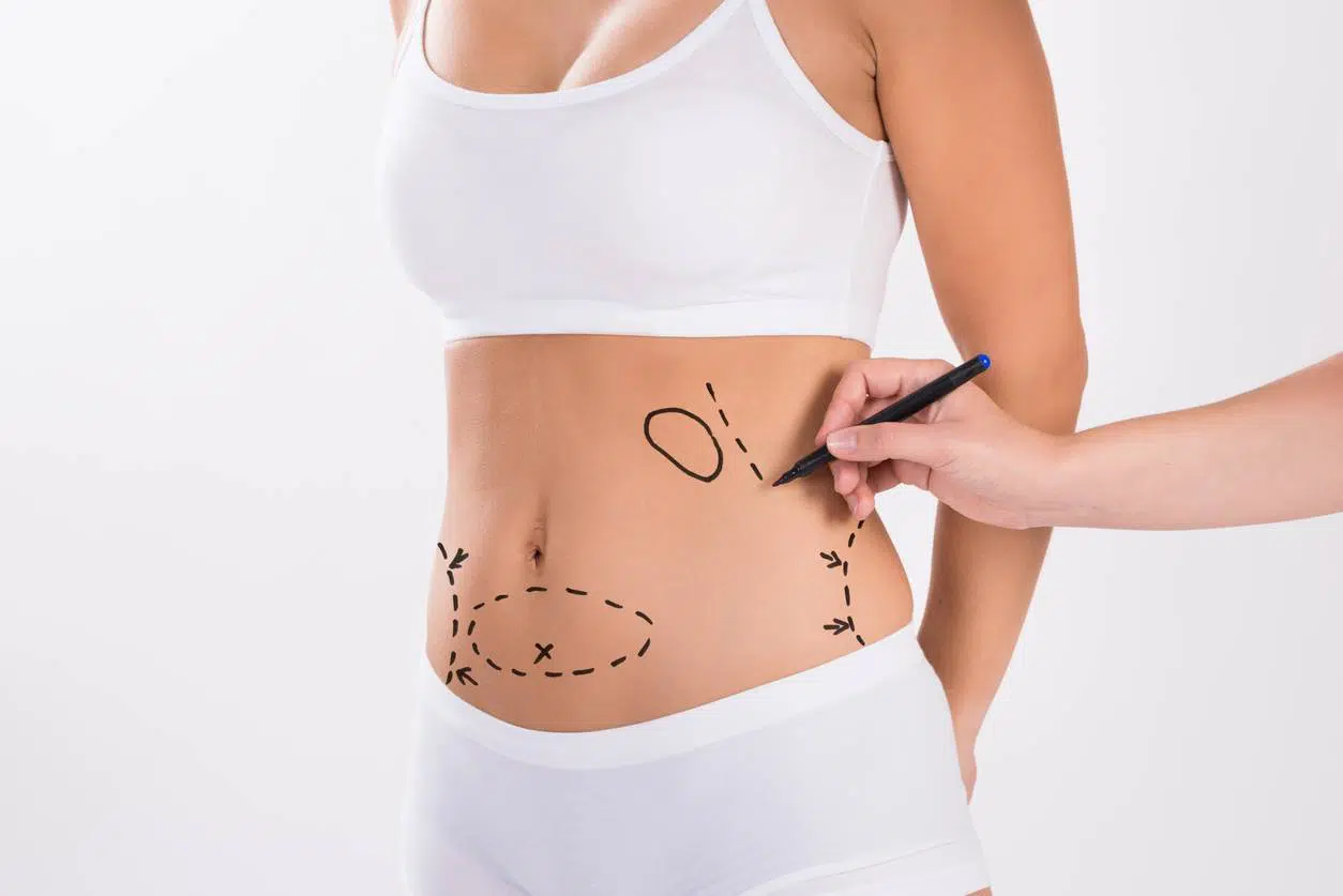 abdominoplastie chirurgie plastique