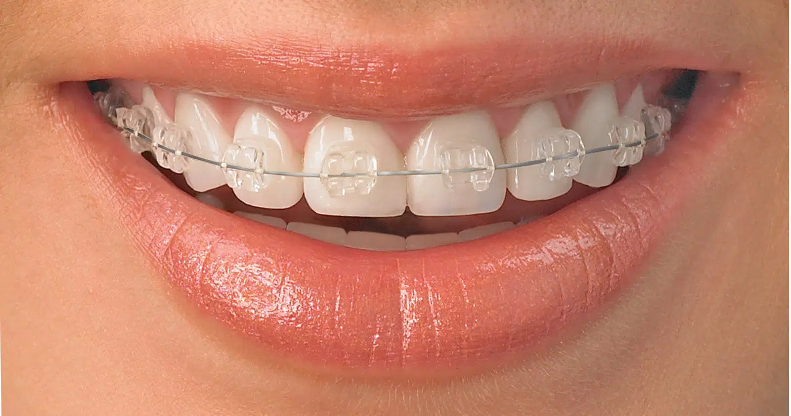 opter pour la solution invisalign